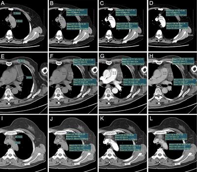 Thymic cyst: Is attenuation artifactually increased on contrast-enhanced CT?